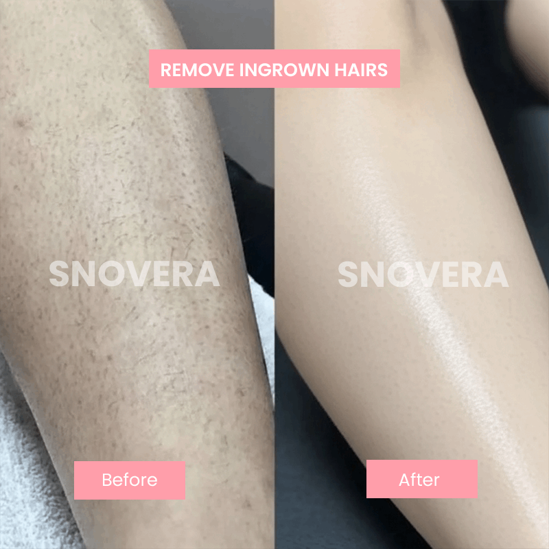 Ahlwo™ Natural Hair Removal Serum - Cyperus Rotundus Oil