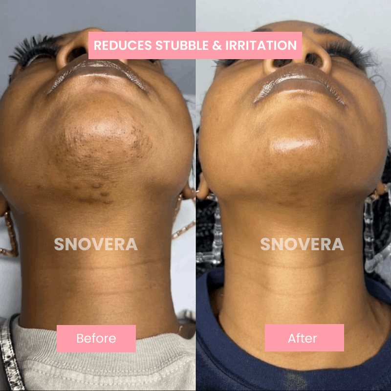 Ahlwo™ Natural Hair Removal Serum - Cyperus Rotundus Oil