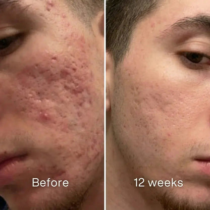 Clinical Acne Scar Repair Stick™