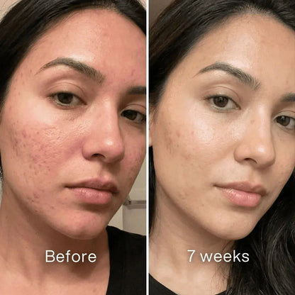 Clinical Acne Scar Repair Stick™