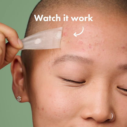 Seurico™ Overnight Hydrocolloid Acne Clear Patches