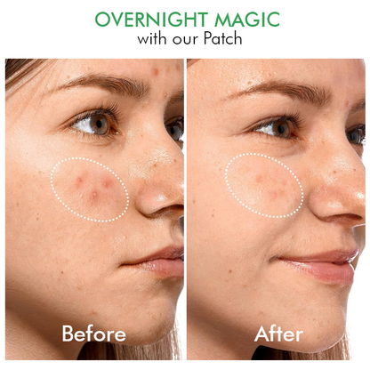 Seurico™ Overnight Hydrocolloid Acne Clear Patches