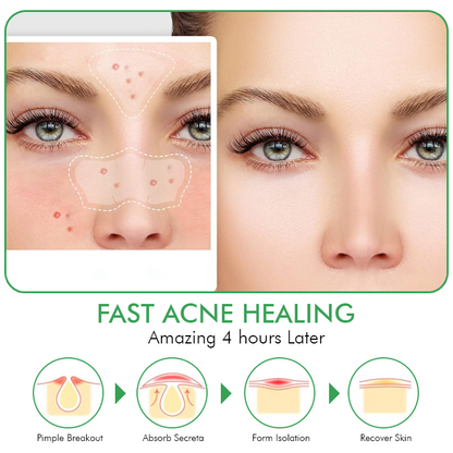 Seurico™ Overnight Hydrocolloid Acne Clear Patches